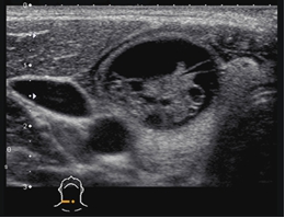 ultrazvuk-dojki